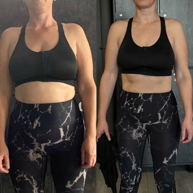 Antes e depois de paciente que perdeu 17 kg
